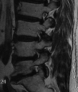 Lumbar Foraminal Stenosis L45 MRI